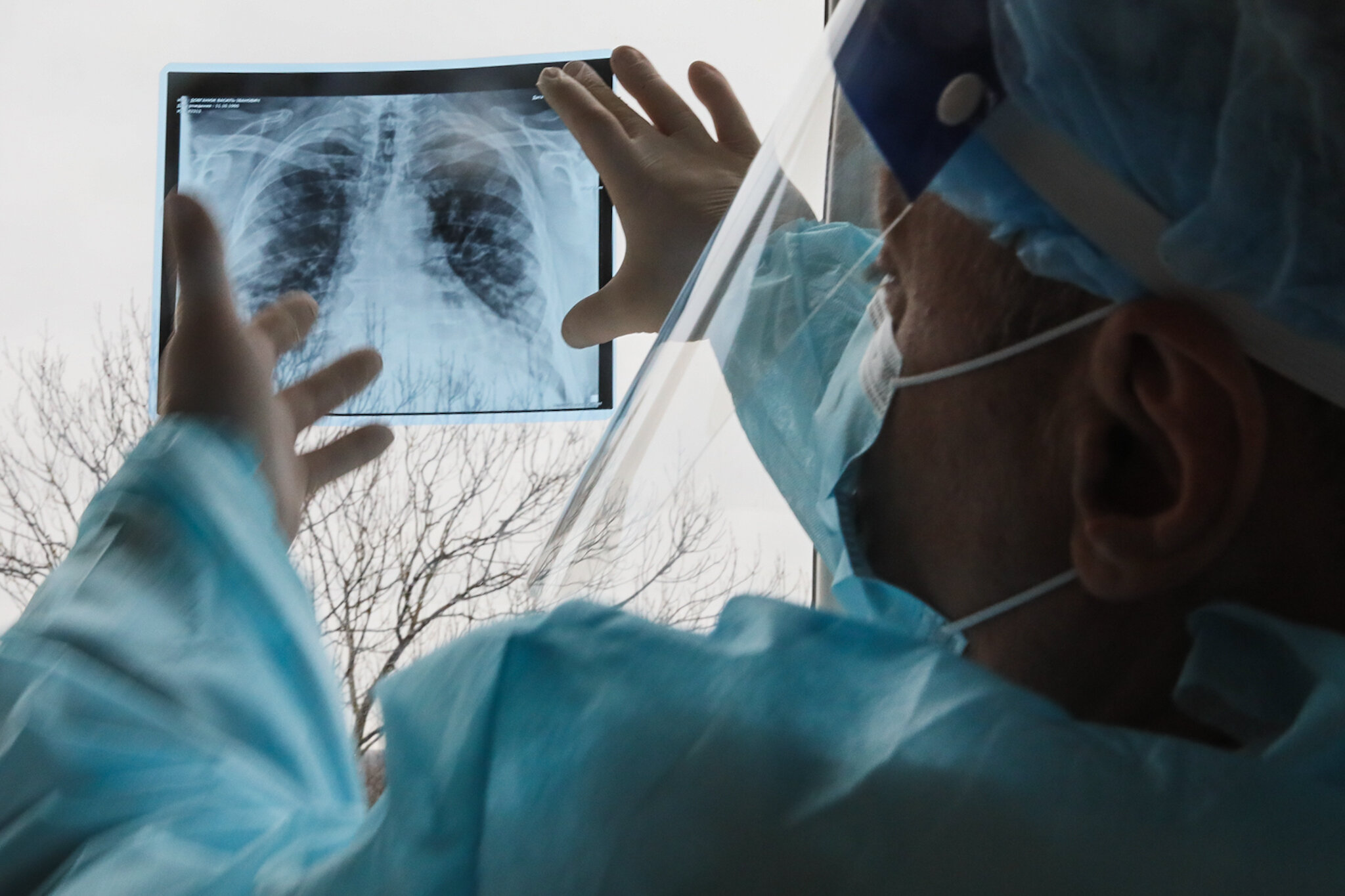 A doctor examines an x-ray of a coronavirus patient&#8217;s lungs at the Kolomyia District Hospital in Ivano-Frankivsk Oblast on March 16, 2021.