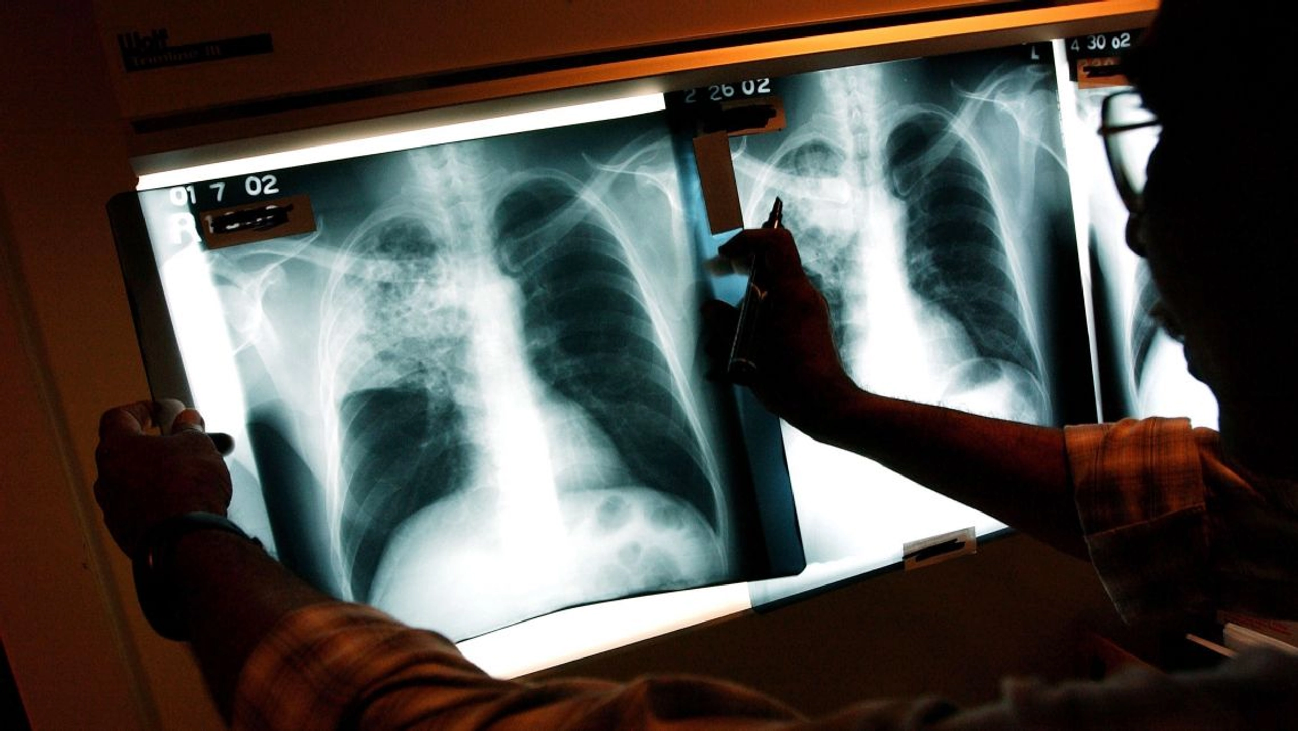 Tuberculosis Ravages Russian Army With Troops Lining up for Hospital Beds, Say Reports