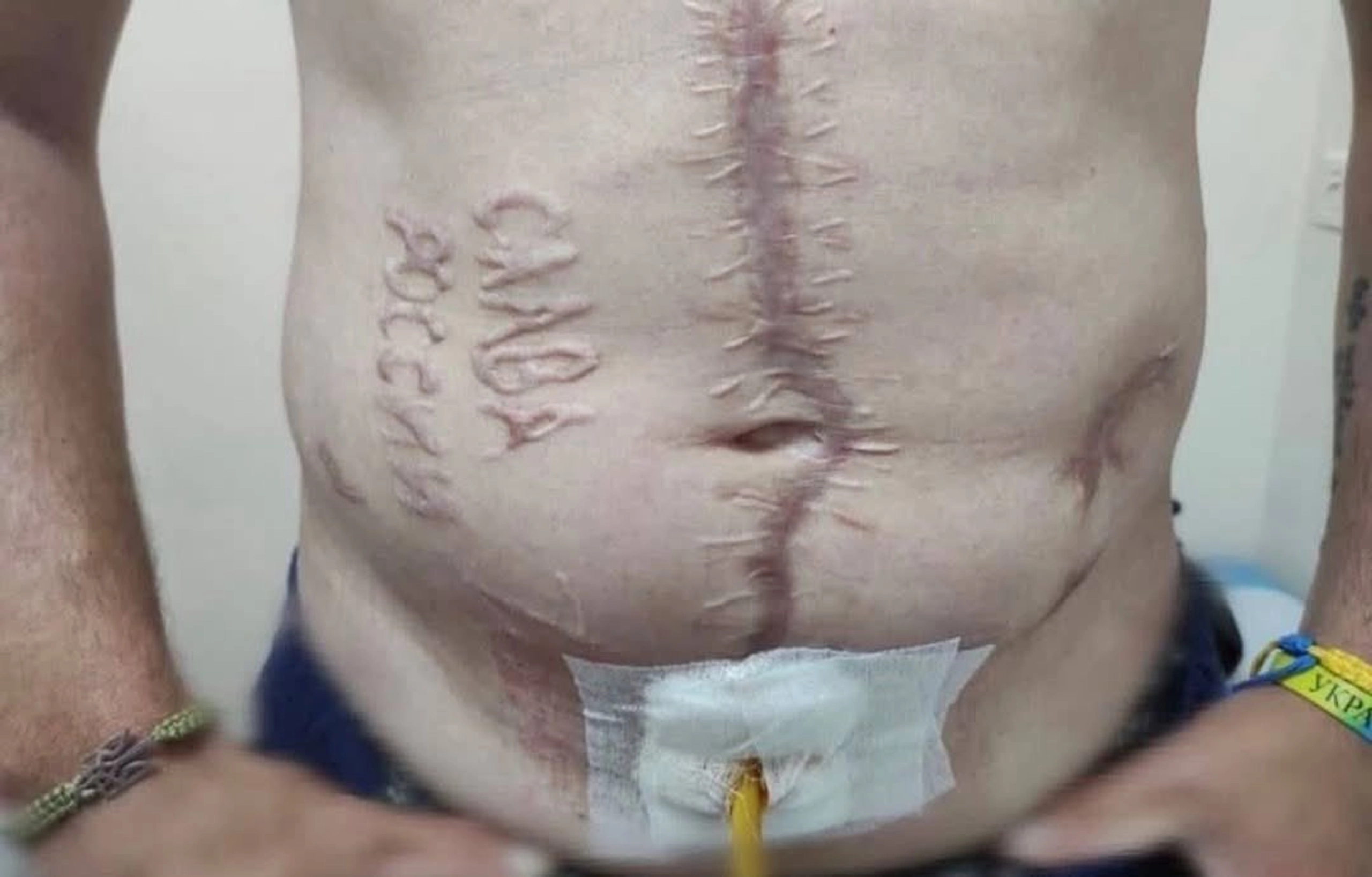 ‘Glory to Russia’ Burned on Ukrainian POW’s Body Confirmed Authentic